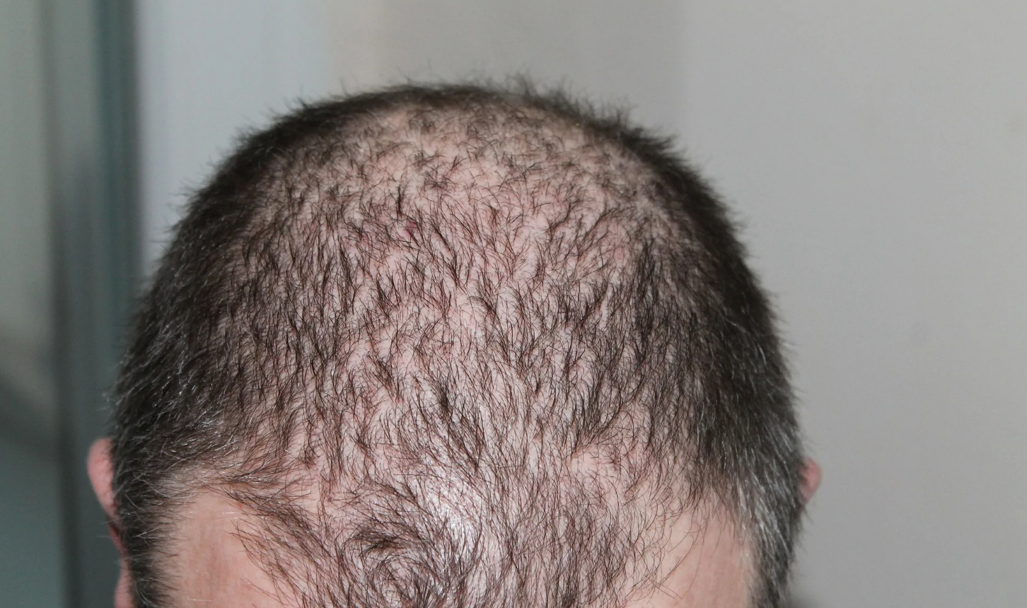 A man's scalp showing thinning hair. Concept of hair thinning solutions, hair thickening solutions.